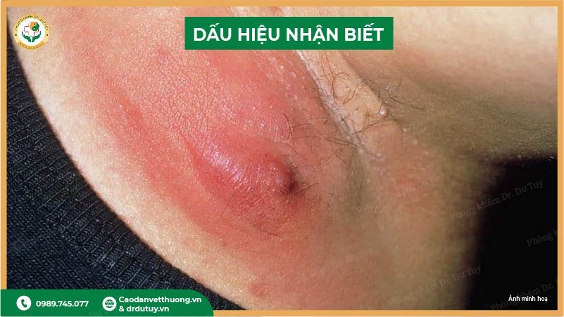 dau-hieu-mun-nhot-o-nach