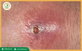 Vết thương hở bị nhiễm trùng: 5 dấu hiệu báo động đỏ cho sức khỏe của bạn