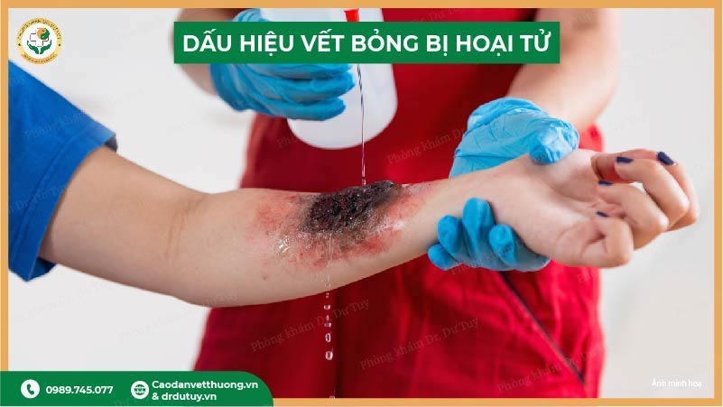 dau-hieu-vet-bong-hoai-tu