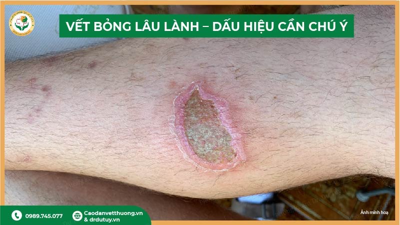 dấu hiệu vết bỏng lâu lành