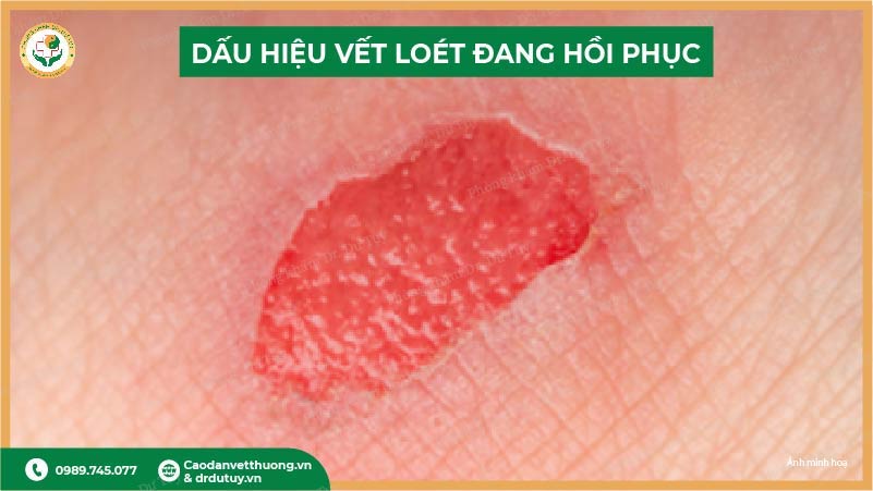 dau-hieu-vet-loet-hoi-phuc(1)