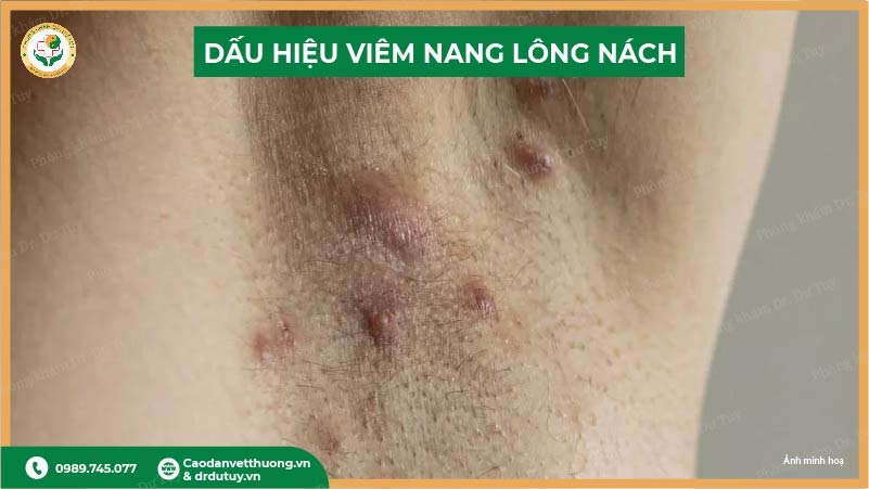 dau-hieu-viem-nang-long-nach
