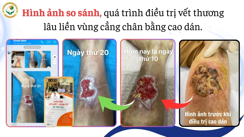 diễn tiến vết thương cẳng chân ngày 10, ngày 20
