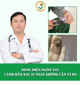 Điều trị bỏng điện ngón tay