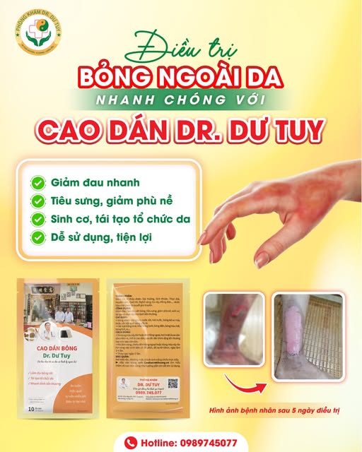 dieu-tri-bong-don-gian-va-hieu-qua-tai-nha-nho-cao-dan-dr-du-tuy