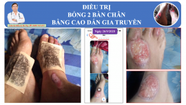 Điều trị vết bỏng gây lở loét da bằng cao dán Đông y tại Ninh Bình
