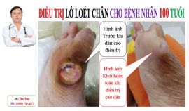 Điều trị vết thương loét da bị hoại tử bằng cao dán Đông y gia truyền tại Quảng Ninh