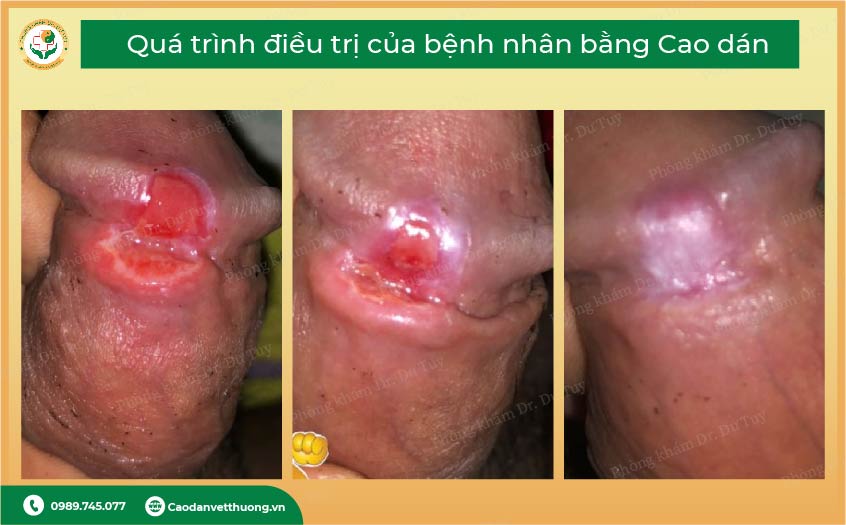 điều trị lở loét dương vật