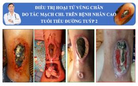 Điều trị hoại tử da cho bệnh nhân bị tiểu đường tại Nam Định