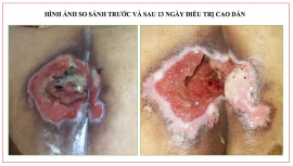 Chuyên điều trị các vết lở loét mất da tại Thái Bình
