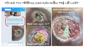 Điều trị lở loét da bằng cao dán Đông y tại Hồ Chí Minh