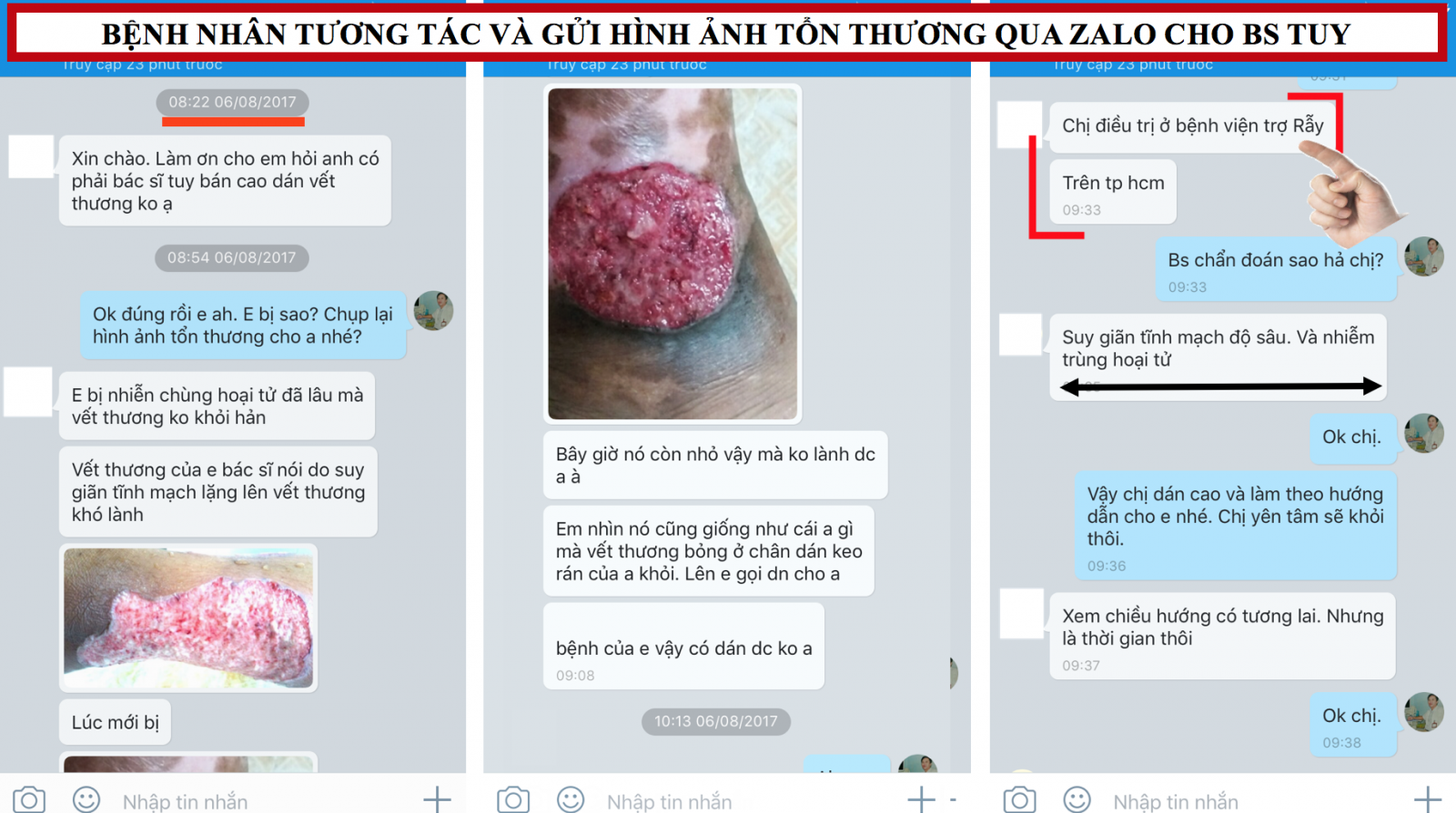 dieu-tri-loet da-do-suy-van-tinh-mach