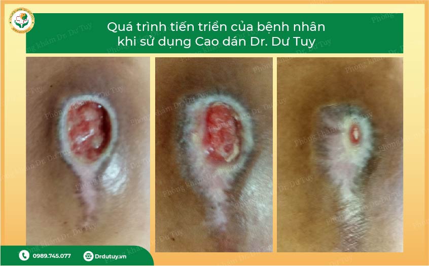 điều trị loét do nằm lâu