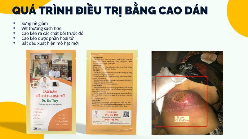 dieu-tri-loet-ty-de-bang-cao-dan-1