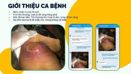 Điều trị loét tỳ đè của bà cụ 76 tuổi ở Hà Nội