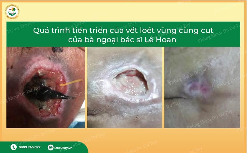 điều trị loét tỳ đè vùng cụt