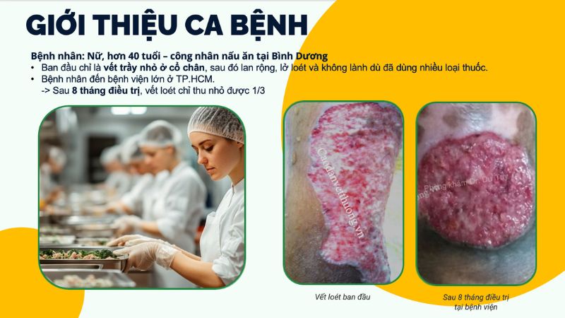 điều trị vết loét