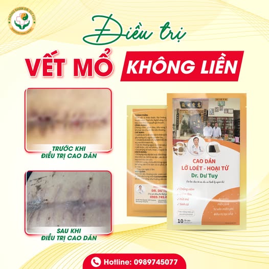 dieu-tri-vet-mo-khong-lien-hieu-qua-voi-cao-dan-dr-du-tuy