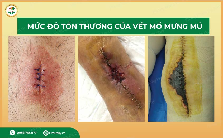 điều trị vết mổ mưng mủ tại nhà