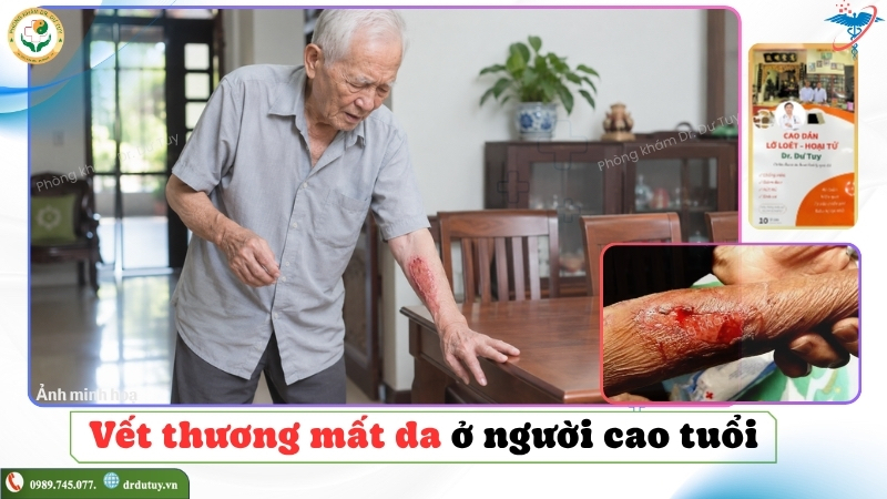 dieu-tri-vet-thuong-mat-da-o-nguoi-cao-tuoi(1)