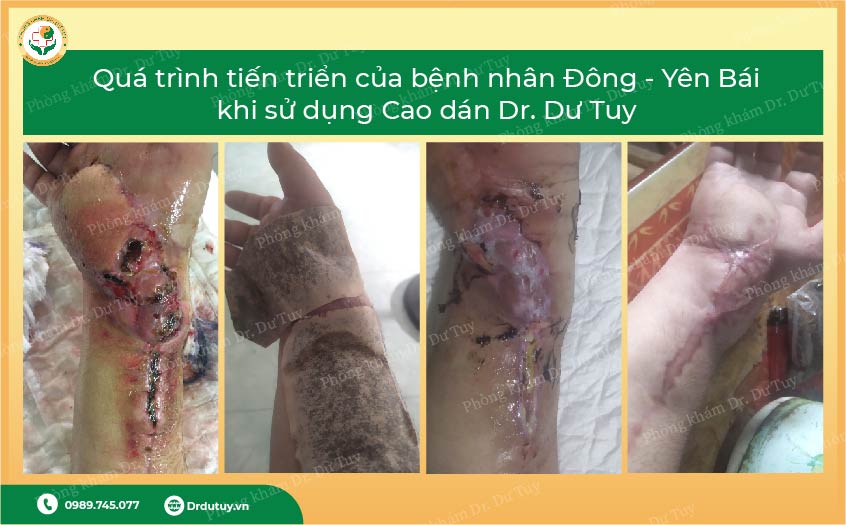 dieu-tri-viem-sau-mo-bang-cao-dan-dong-y