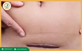 Dính vết mổ là gì? Nguyên nhân và cách điều trị hiệu quả