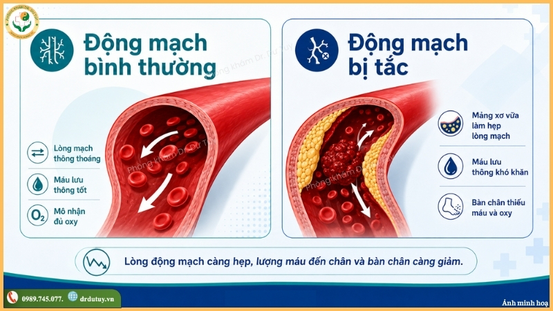 dong-mach-binh-thuong-va-dong-mach-bi-tac