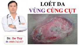 Dứt điểm loét da tì đè, không cần phẫu thuật ghép da