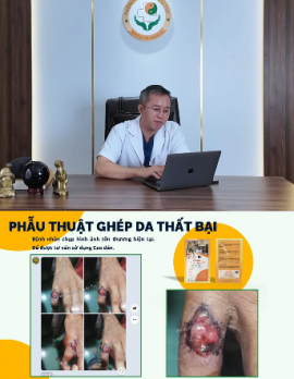 Ghép Da Không Thành Công: Hiểm Họa Hoại Tử Ngón Tay Và Giải Pháp Phục Hồi An Toàn