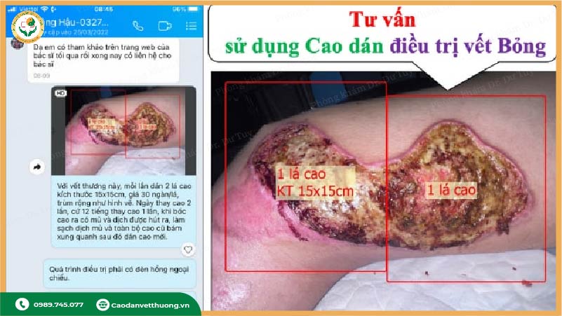 giai-doan-phuc-hoi-vet-bong