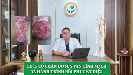 Cao dán Dr. Dư Tuy – Giải pháp phục hồi vết loét cổ chân mãn tính sau khi thất bại điều trị tại bệnh viện lớn TPHCM