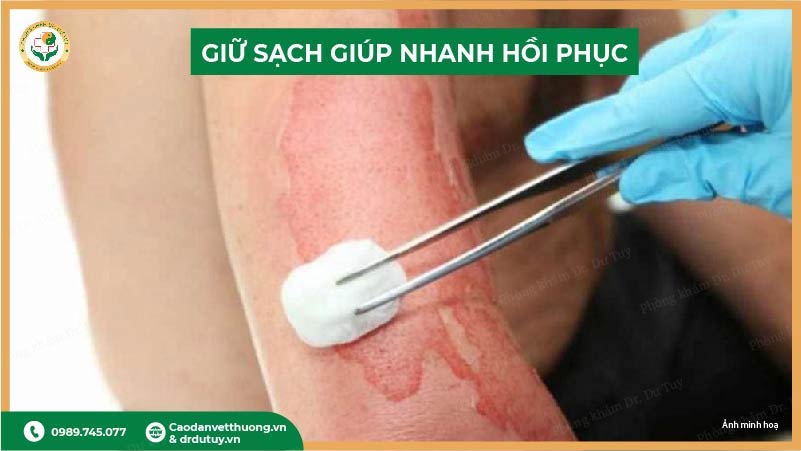 giữ sạch vết bỏng giúp nhanh hồi phục