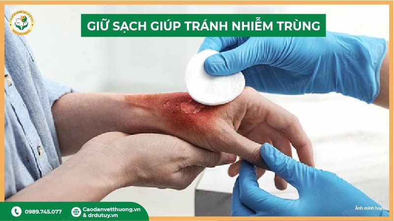 giữ sạch vết bỏng phồng nước giúp tránh nhiễm trùng