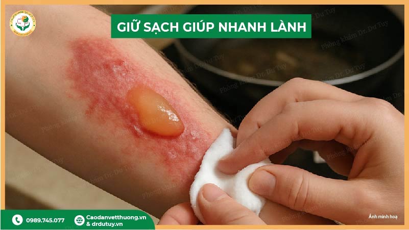 giữ sạch vết bỏng tại nhà
