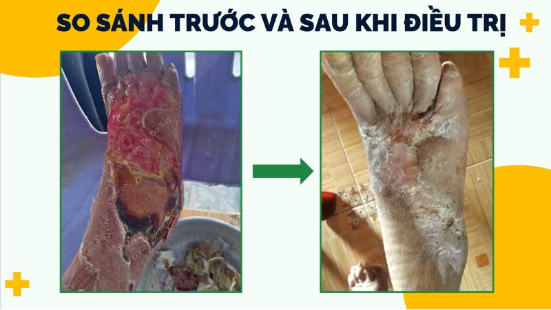 hậu quả nước lũ