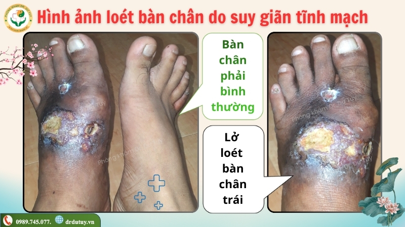 hinh-anh-loet-ban-chan-do-suy-gian-tinh-mach