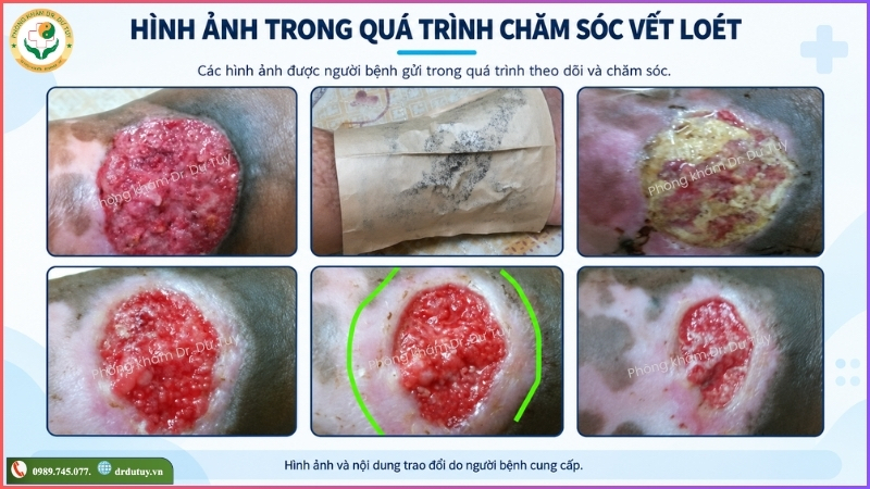 hinh-anh-qua-trinh-cham-soc-vet-loet