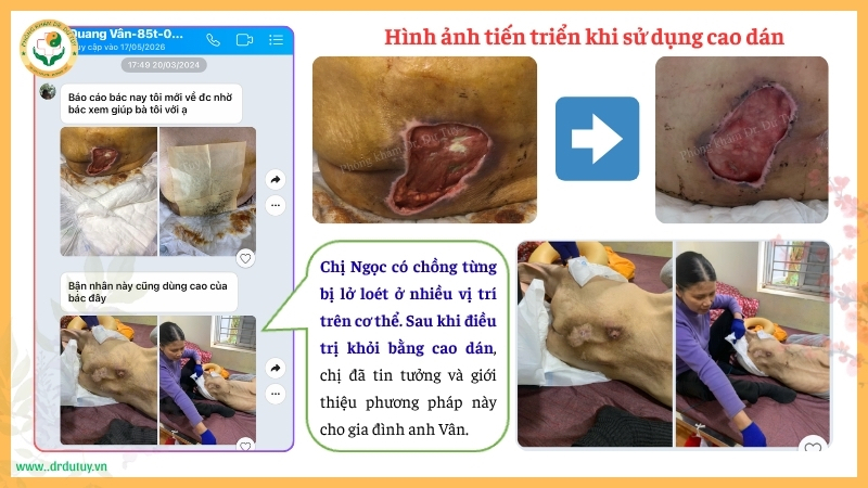 hình ảnh tiến triển vêt sloets sau khi dùng cao dán
