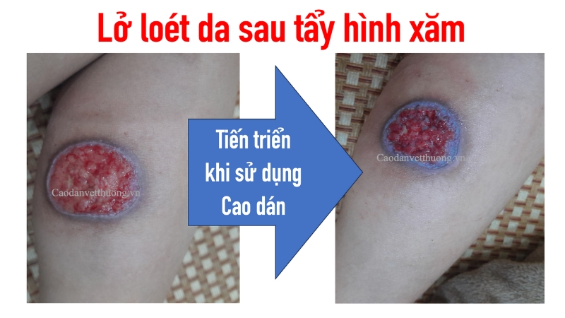 Hình xăm bị sưng có sao không?