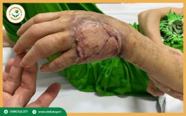 Hoại Tử Bàn Tay: Biến Chứng Sớm Nguy Hiểm Bắt Đầu Từ Những Dấu Hiệu Nhỏ