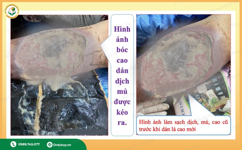 hoai-tu-chan-co-chua-duoc-khong6