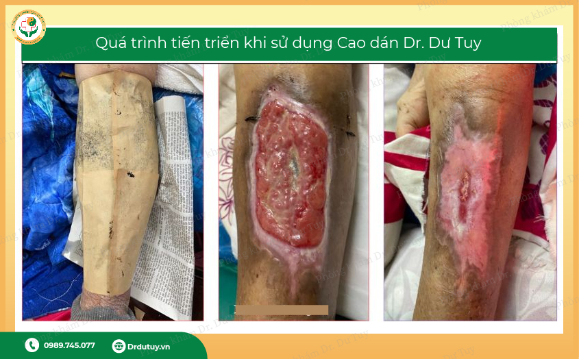 hoai-tu-chan-co-chua-duoc-khong7