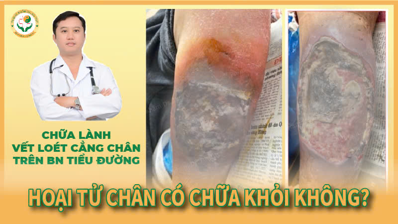 hoai-tu-chan-co-chua-khoi-duoc-khong3