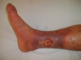 Hoại tử chân: Nguyên nhân Bàn chân bị lở loét