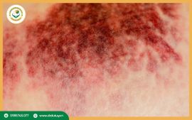 Phân biệt hoại tử khô và hoại tử ướt: Đặc điểm nhận dạng và phương pháp xử lý.