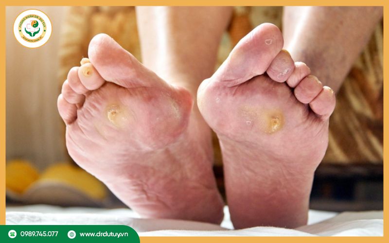 hoai-tu-ngon-chan-do-benh-tieu-duong