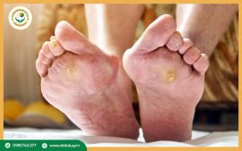 Hoại tử ngón chân do bệnh tiểu đường