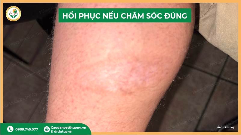 hồi phục nếu chăm sóc đúng vết bỏng phồng nước