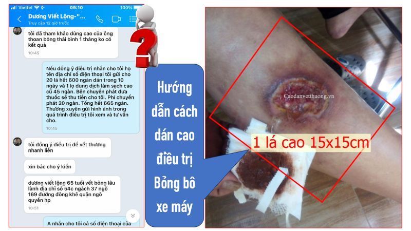 hội thoại tư vấn bỏng