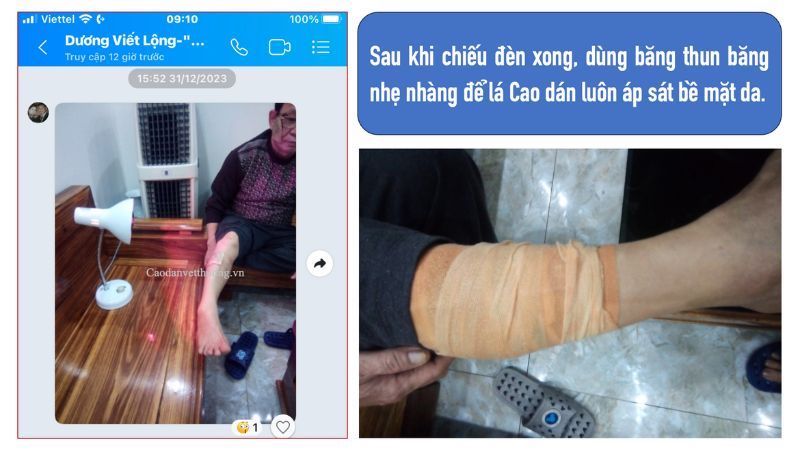 hướng dẫn dán cao bỏng